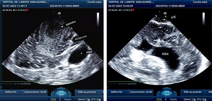 左圖顯示術(shù)中超聲見囊實性病變，大小約為4x4x3cm，病灶周圍腦組織水腫明顯；右圖為病灶切除后，術(shù)中超聲示術(shù)腔無病變殘留