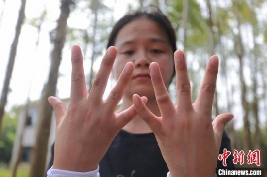 吳素英展示被蜜蜂蜇過的雙手。湯曉逵 攝