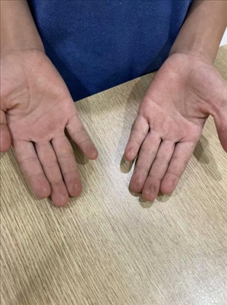 9歲小學(xué)生長期拍煙卡，手部粗糙長繭。受訪者供圖