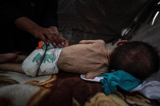 這是5月28日在加沙城西部一處臨時安置點拍攝的一名營養(yǎng)不良的嬰兒。新華社發(fā)（馬哈茂德·扎基攝）